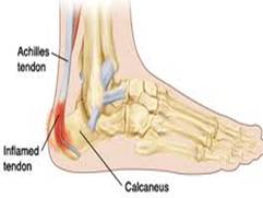 Sever's Disease - Heel pain - Greg Robinson Podiatrist