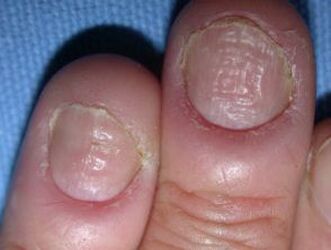 Paronychia - an infection of the skin around the nails